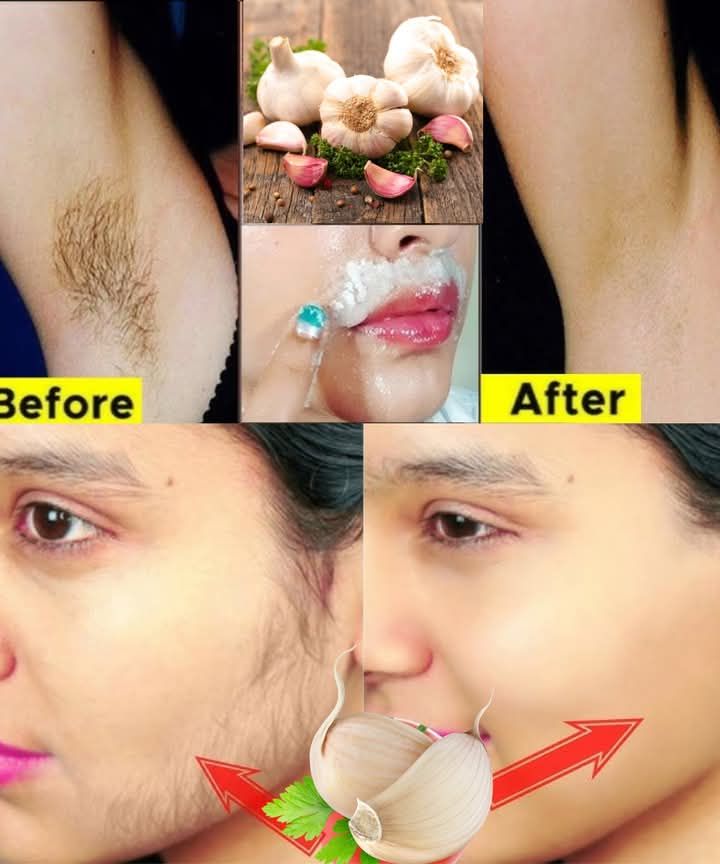 Stop shaving! Here’s how to permanently get rid of facial, body and pubic hair