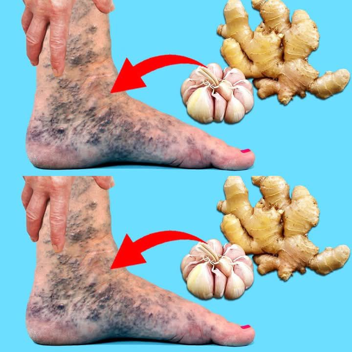 Apply This Mixture Before Bed and Say Goodbye to Varicose Veins