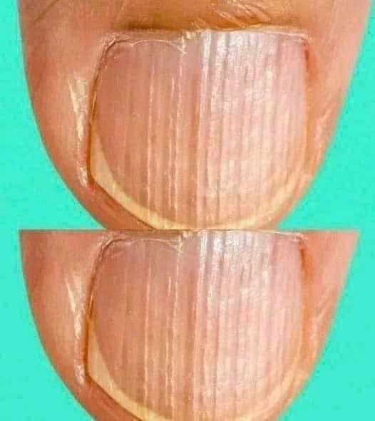 Having striped nails might mean that your body is…