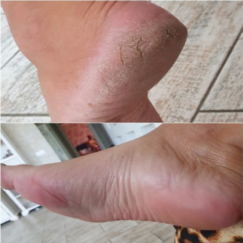 Heels like a baby in 3 to 5 minutes. I’ll show you the progress and my results.