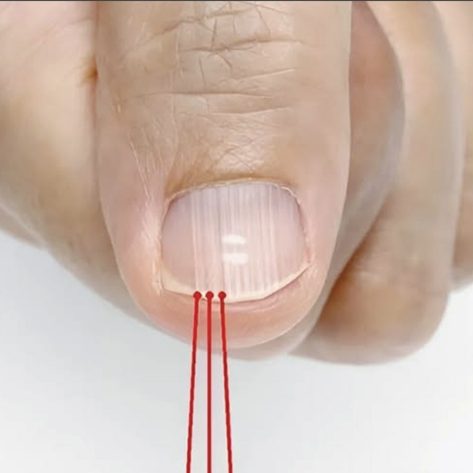 If you have these lines on your nails it is a clear sign that… see more