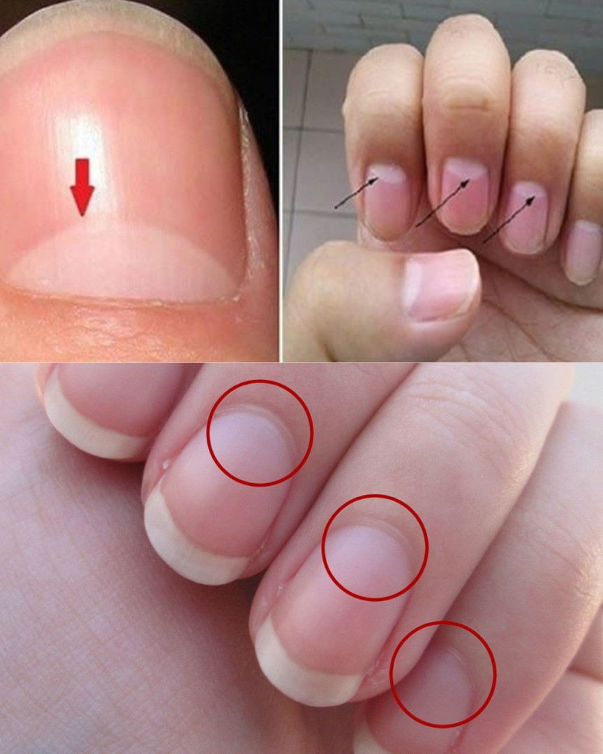 What It Means If You Don’t Have a Crescent Moon on Your Nails (Lunula) – Is It a Health Concern?